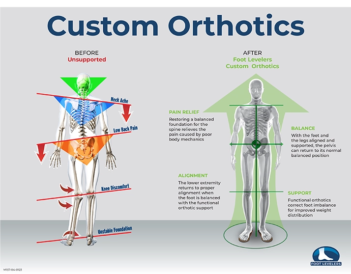 Custom Orthotics graphic showing the before and after the use of Foot Levelers.